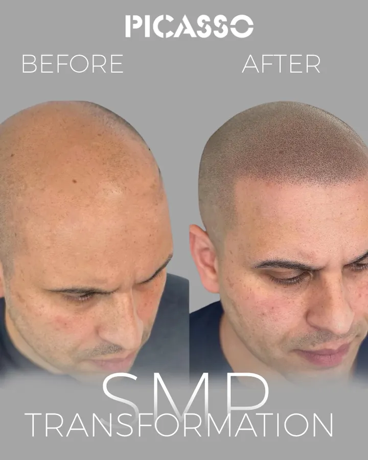 Picasso Jeff: scalp and frontal hairline before and after scalp micropigmentation, viewed from above
