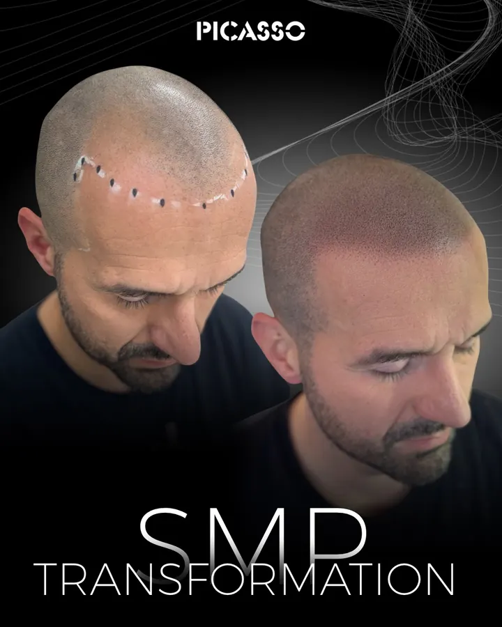 Picasso Jeff: marked hairline and finished SMP result shown side by side