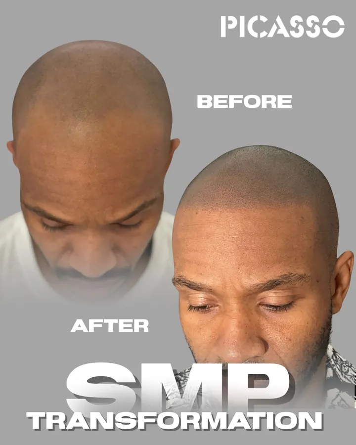 Picasso Jeff: scalp appearance before and after SMP treatment on darker skin