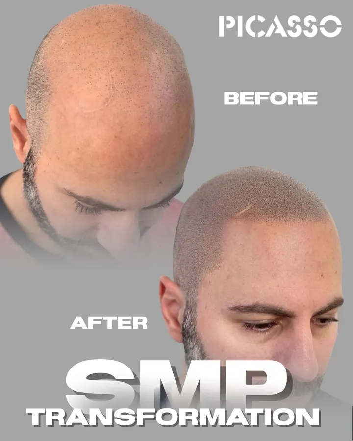 Picasso Jeff: frontal hairline and the appearance of density after SMP, before-and-after comparison