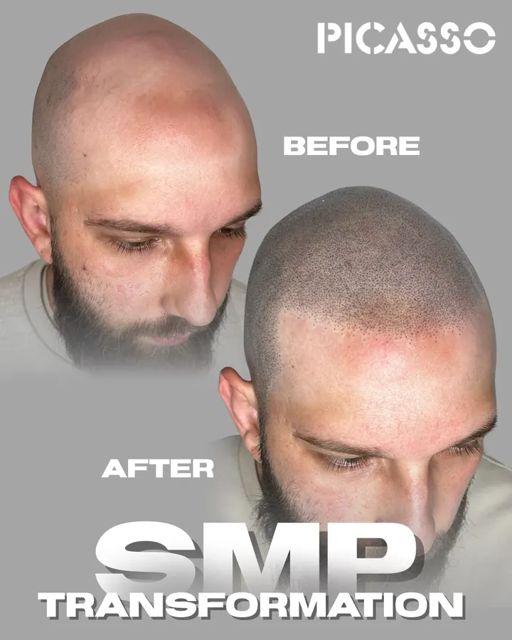 Picasso Jeff: SMP on the front and top of the scalp, before-and-after comparison