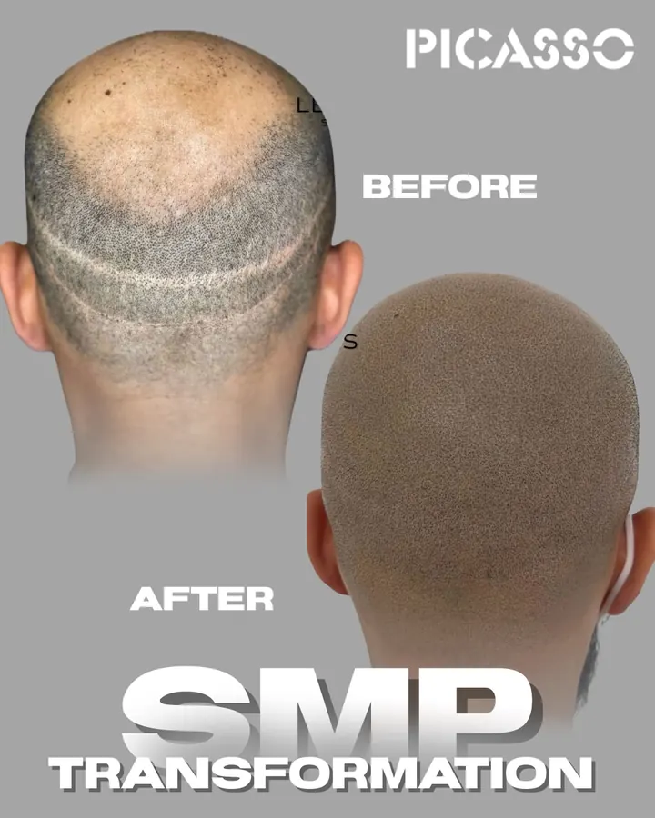 Picasso Jeff: back of the scalp with a visible scar before and after scalp micropigmentation